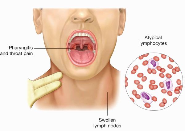 Virus Epstein-Barr gây ung thư vòm họng